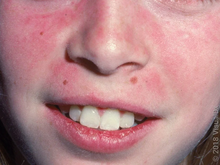 A butterfly rash from lupus in lighter skin.