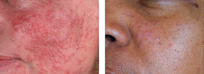Left: Close-up of a cheek with many small red bumps and pus bumps (rosacea). Right: Close-up of a cheek with pink and brown skin bumps (rosacea).