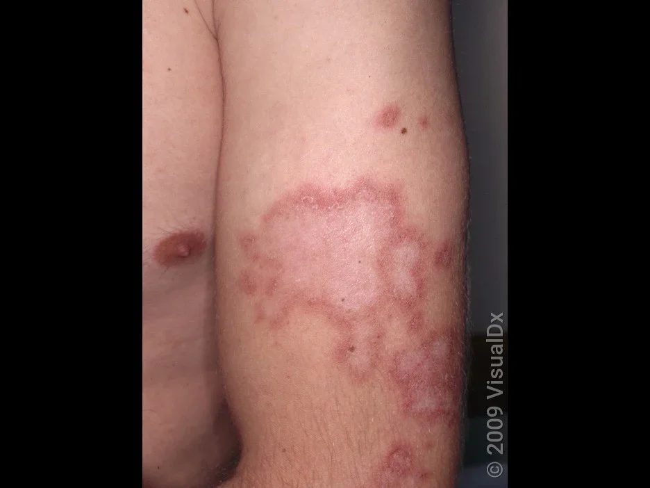 Lupus rash on the arm.