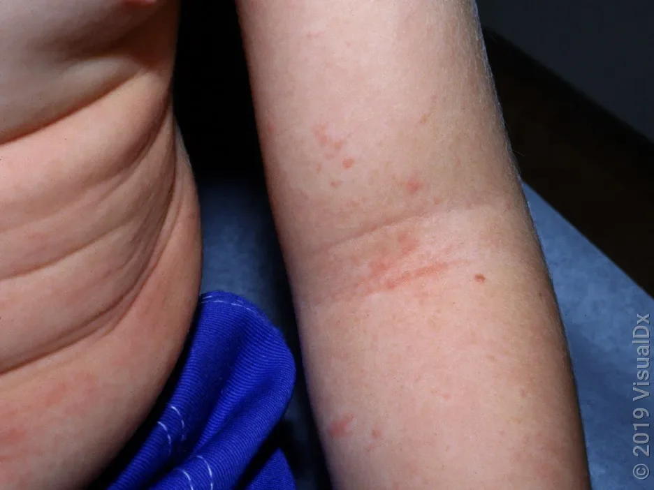 Close-up of an arm with red bumps and lines inside the elbow in scarlet fever.