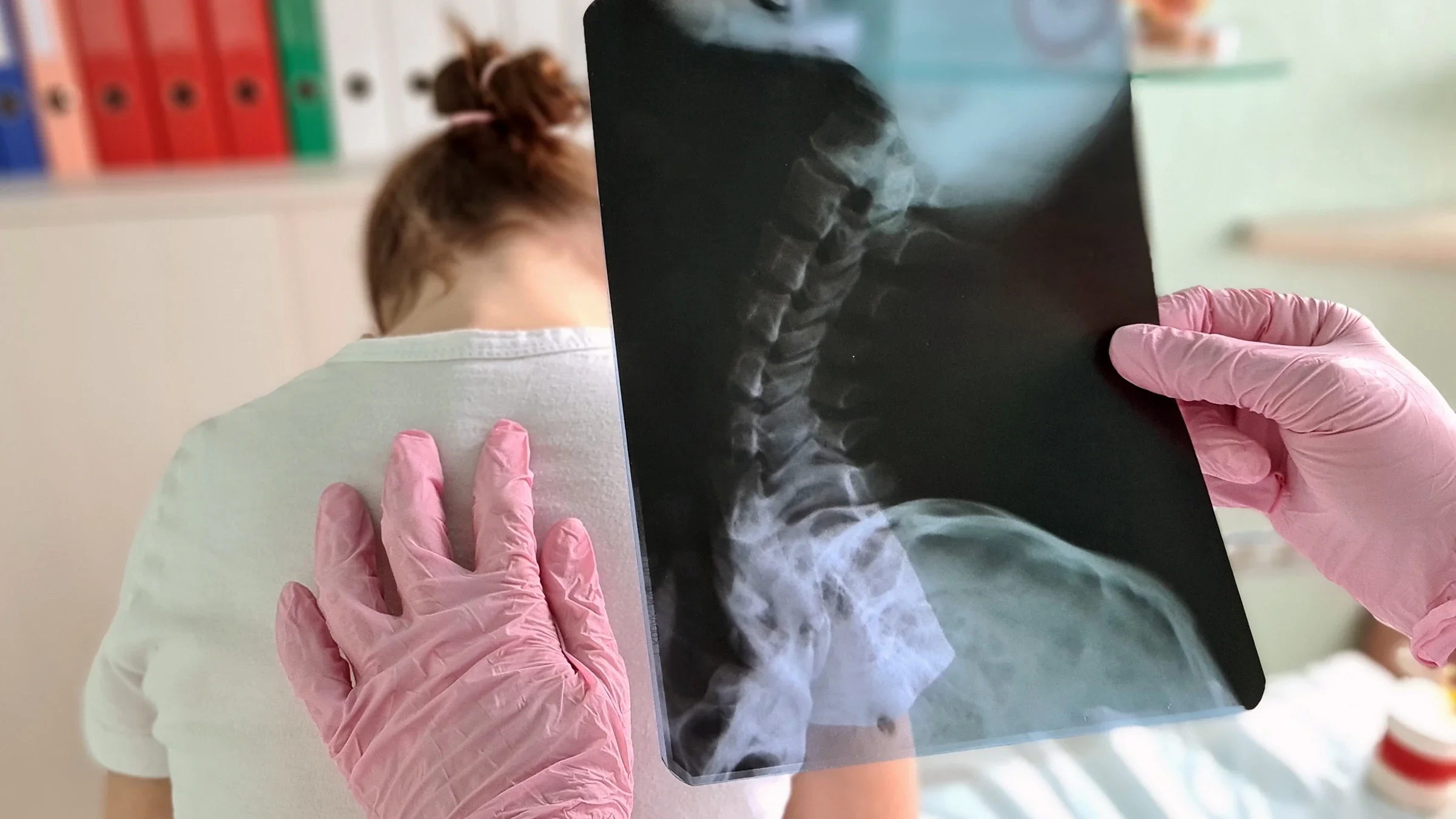Ankylosing Spondylitis: closeup spinal xray 1483299880