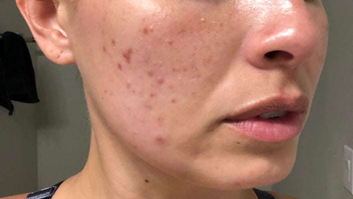 Photo of a woman's cheek with acne