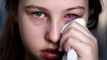 Eye: child with pink eye 144227897