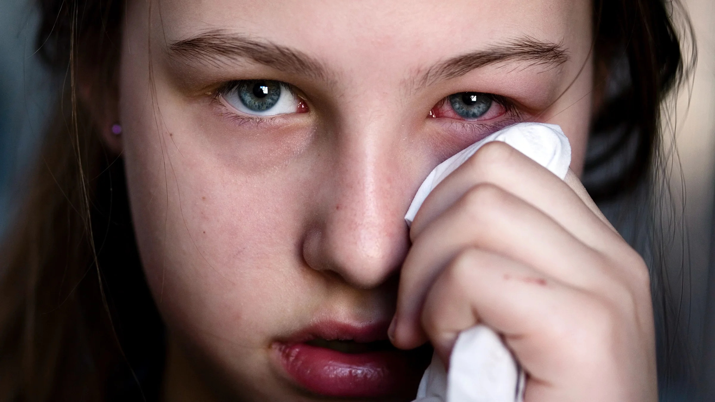 A girl with pink eye wipes her left eye with a tissue.