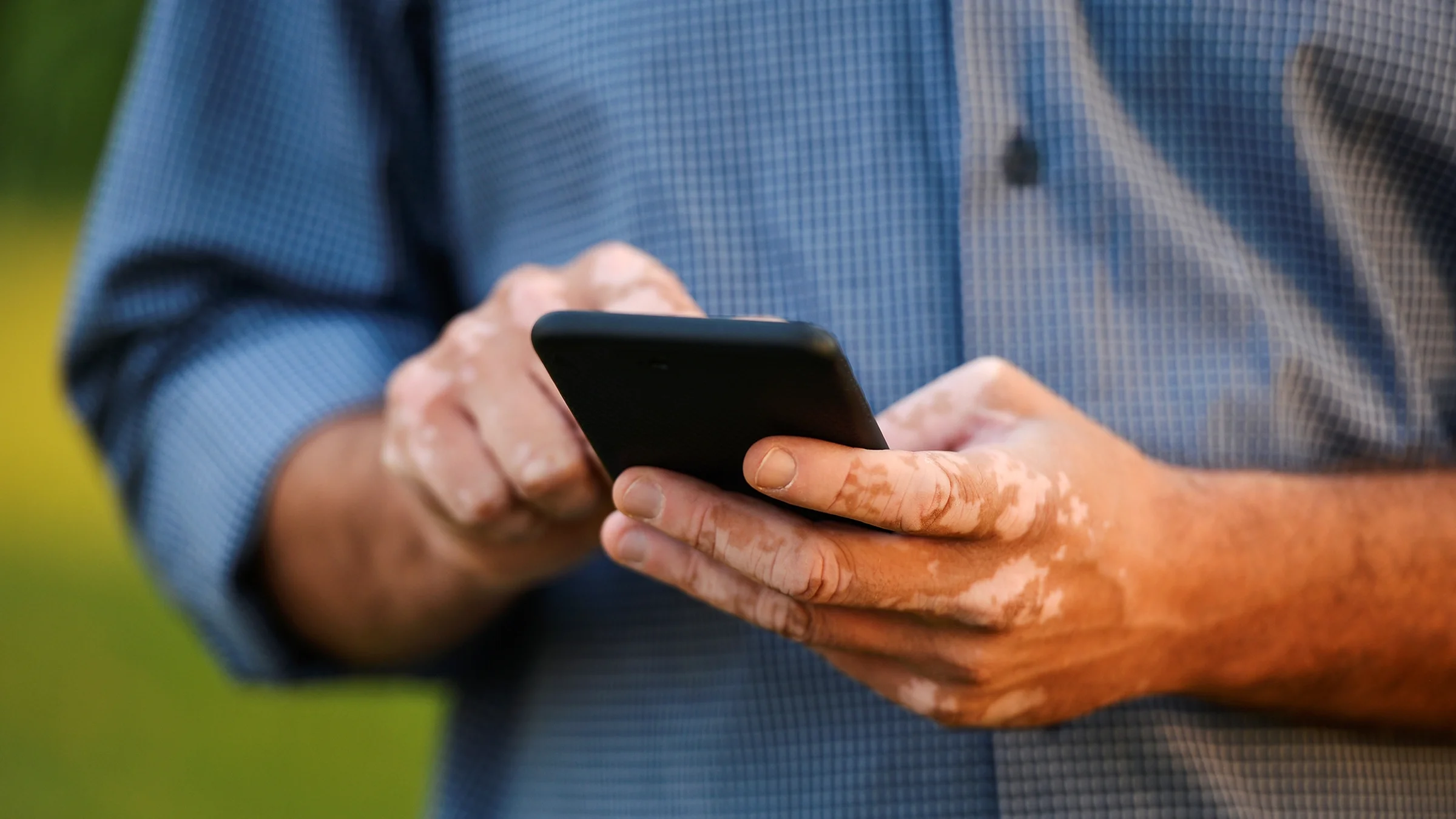 Close-up hands with vitiligo