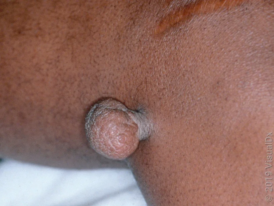 Close-up of a large skin tag. 