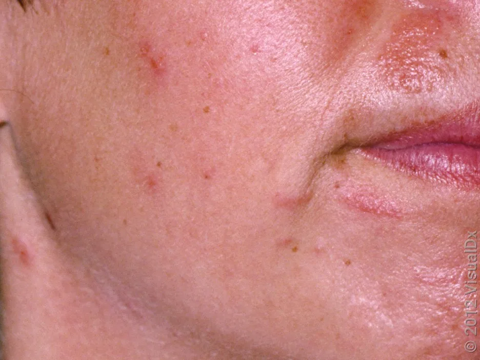 Close-up of allergic contact dermatitis on the face.