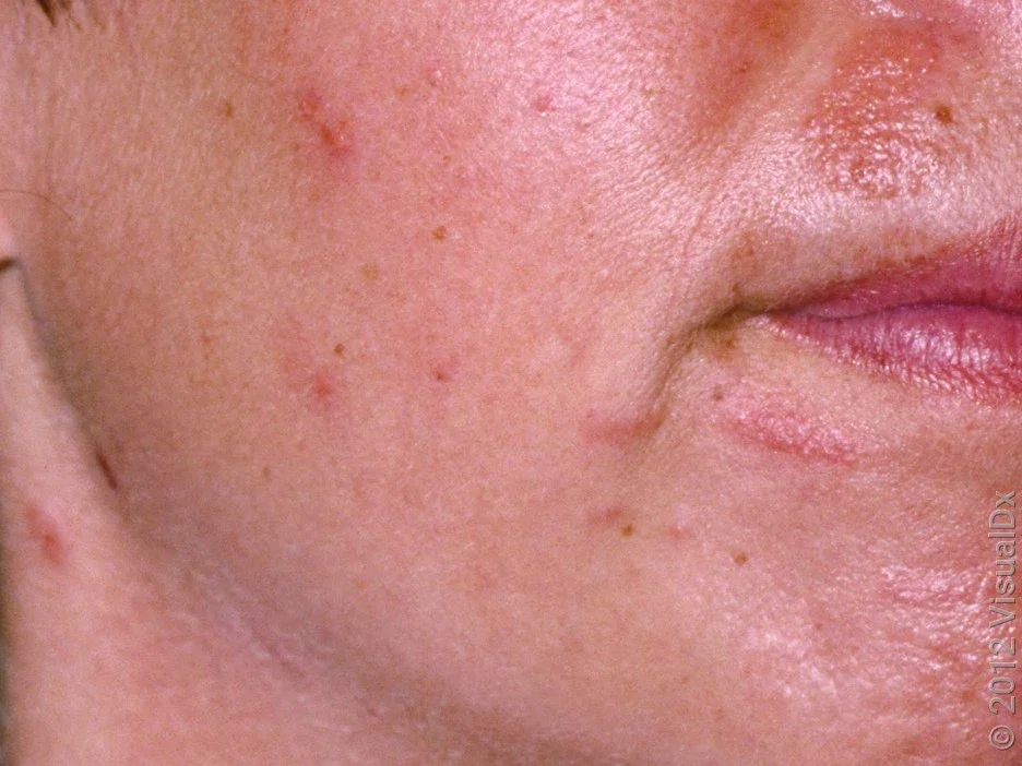 Close-up of allergic contact dermatitis on the face. 