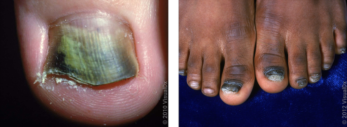 Left: Close-up of nail with black, green, and yellow discoloration. Right: Picture of thickened toenails with black discoloration.  