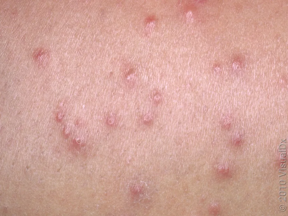 A close-up look at a cluster of flea bites.