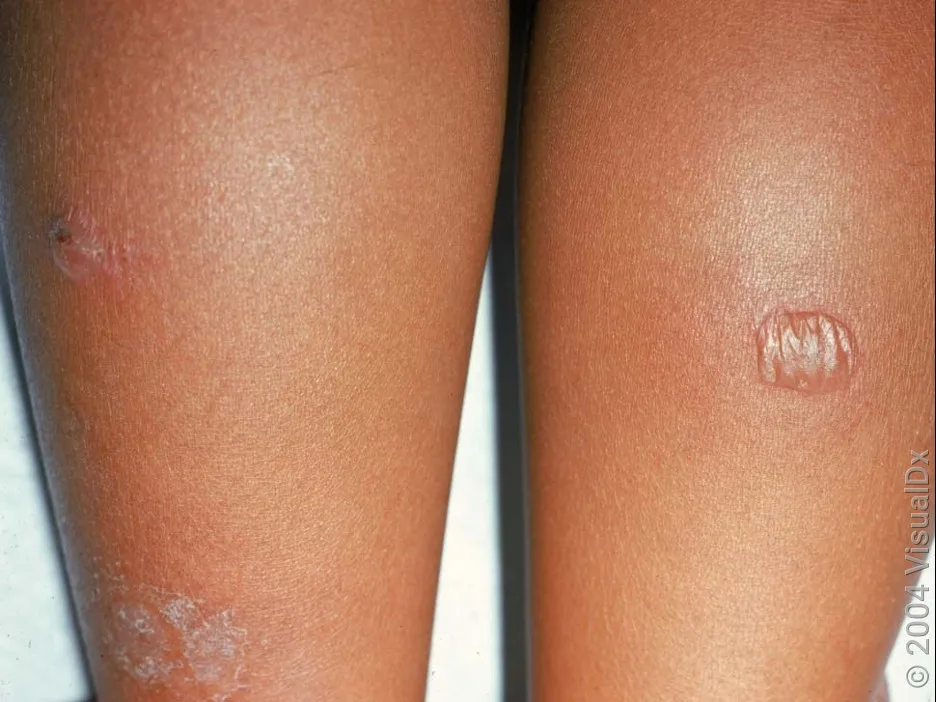 Close-up of bullous impetigo on the legs. 