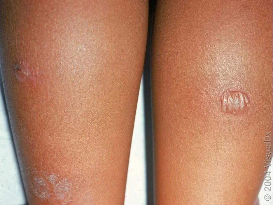 Close-up of bullous impetigo on the legs.