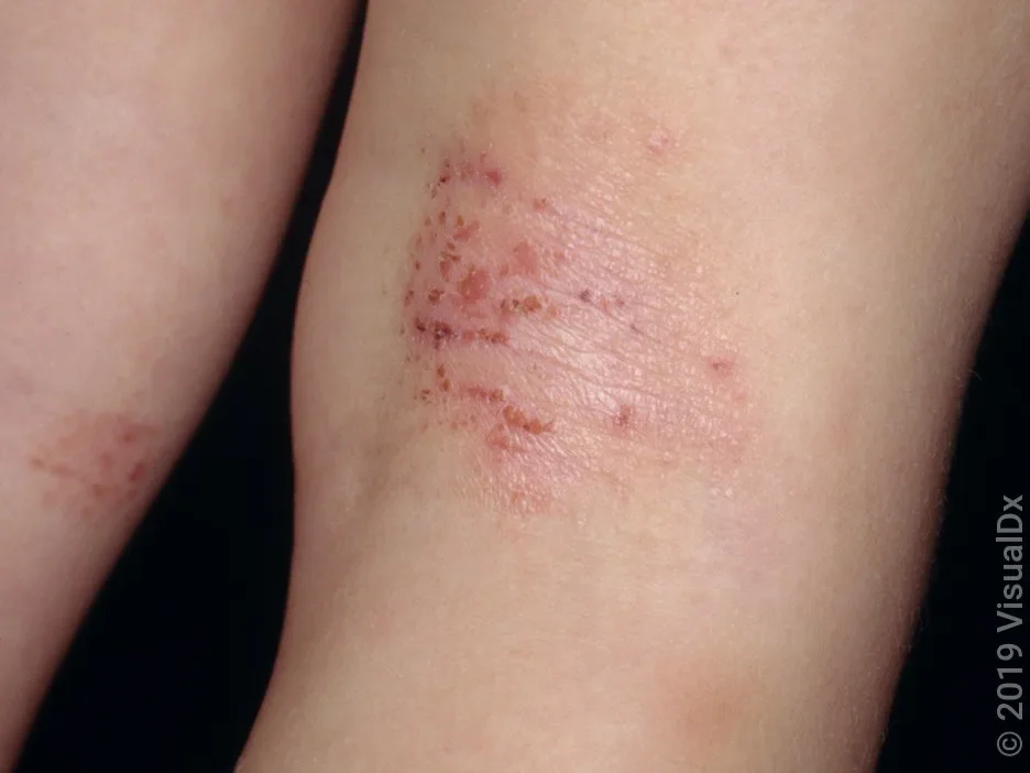 Close-up of eczema (atopic dermatitis) on the back of the knee.