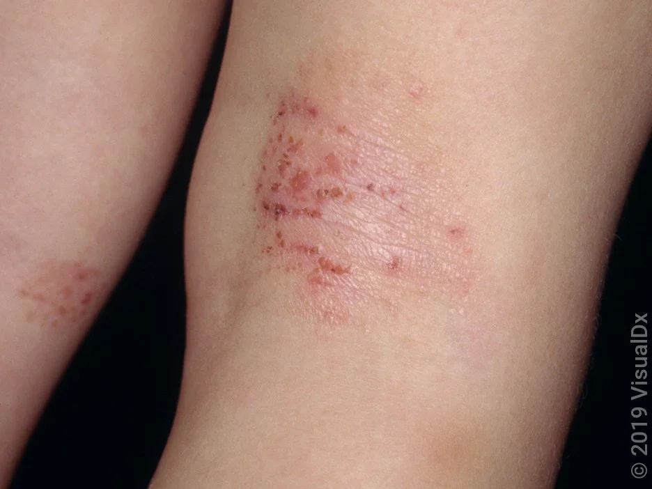 Close-up of eczema (atopic dermatitis) on the back of the knee.