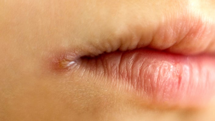 A close-up image shows angulitis on the corner of a mouth.