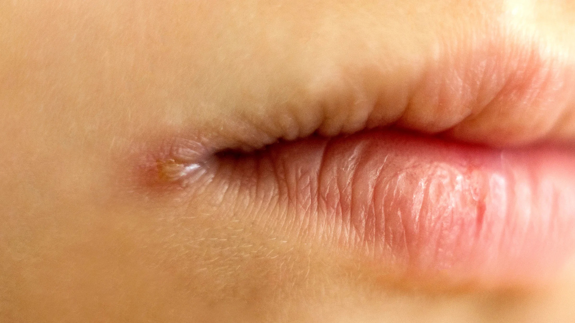 A close-up image shows angulitis on the corner of a mouth.
Irina Zharkova/iStock via Getty Images Plus