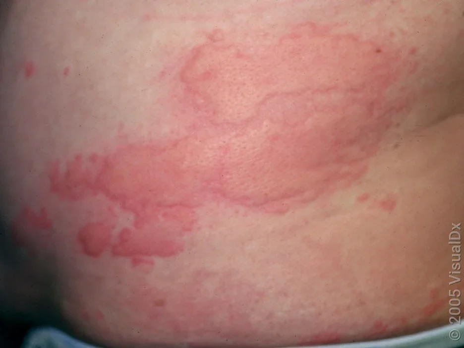 A torso with large red welts (hives). 