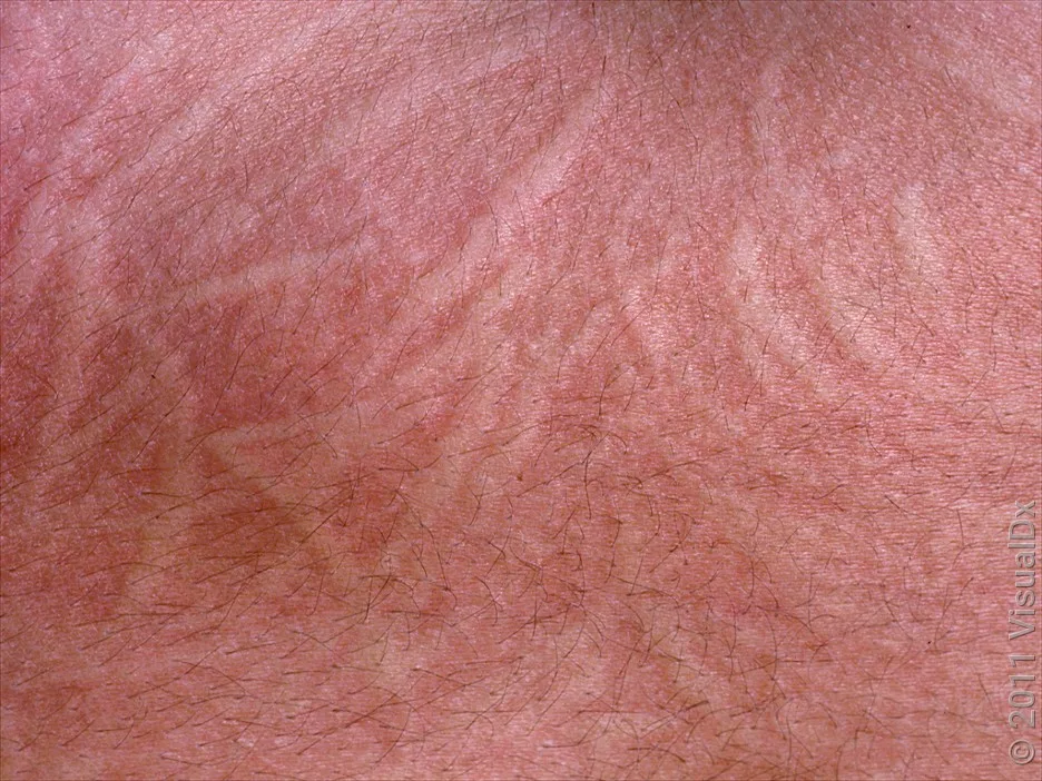 Close-up of raised lines and redness in dermatographia.