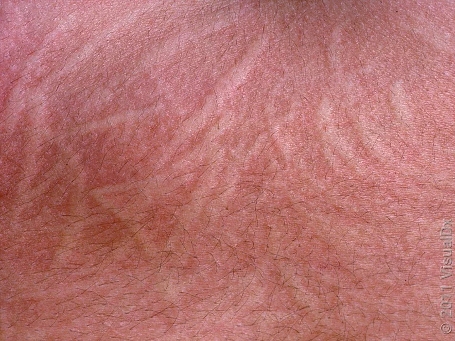 Close-up of raised lines and redness in dermatographia. 