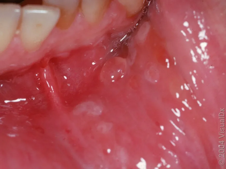 Small blisters and open sores on the inner lip from hand, foot, and mouth disease. 