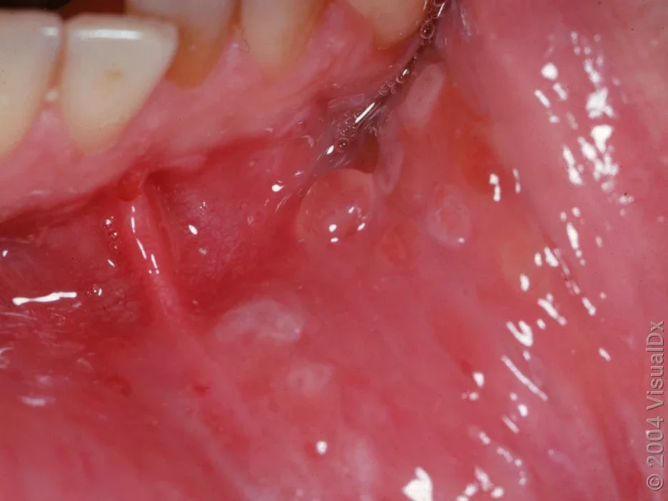 Small blisters and open sores on the inner lip from hand, foot, and mouth disease. 