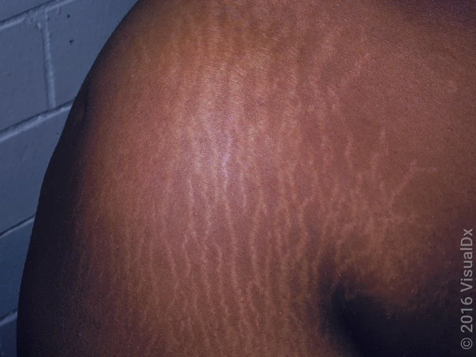 Close-up of stretch marks on the shoulder.
