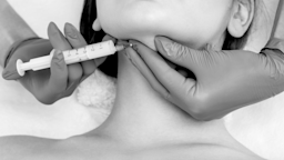 Double chin surgery is a procedure to reduce chin fullness. Fat is removed from beneath the skin, and the area is sculpted to create a more structured profile.