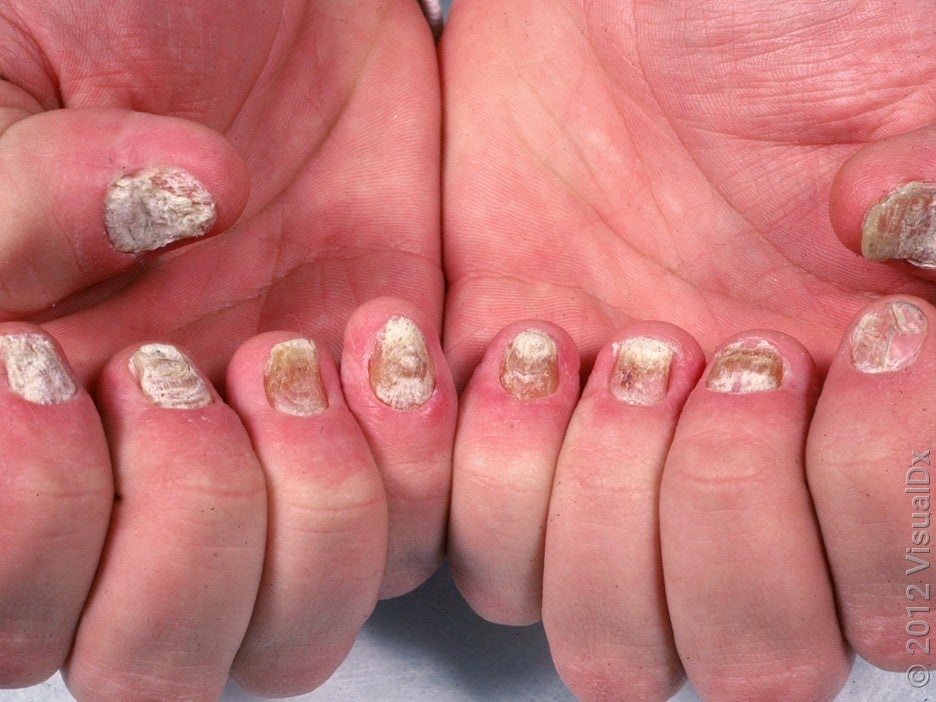 8 Ways Psoriatic Arthritis Affects the Nails GoodRx