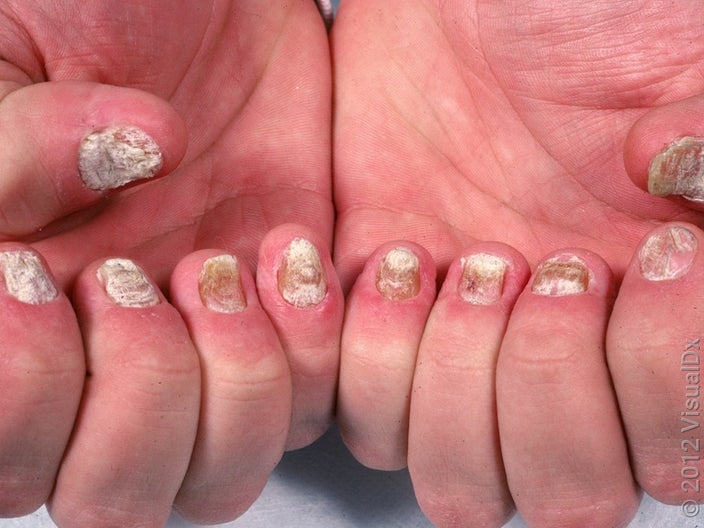 Two hands with very thickened fingernails from psoriasis. 