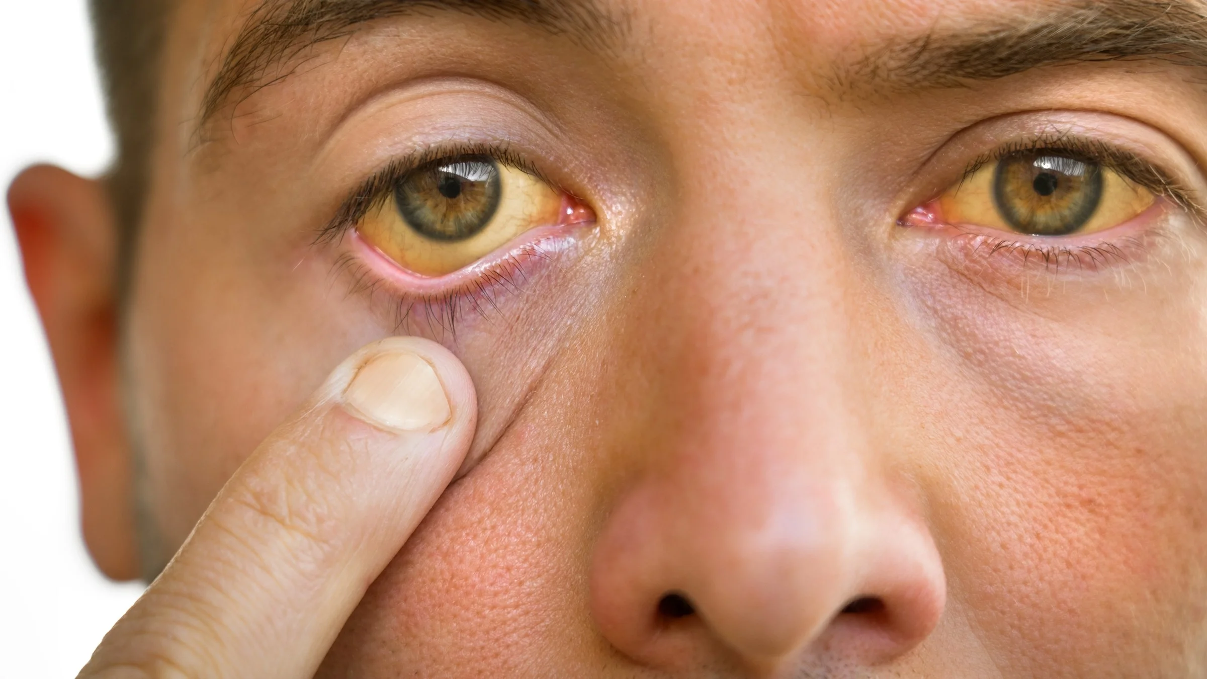Close-up of a person’s jaundiced yellow eyes as they pull their lower eyelid down with one finger.