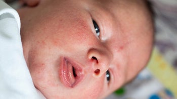 children's health: closeup baby acne 1553549990