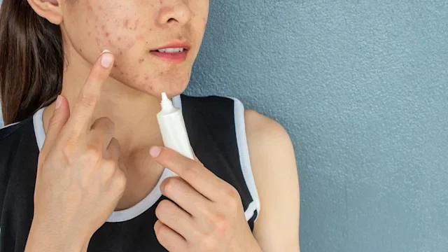 Fungal Acne (Pityrosporum Folliculitis): Causes, Symptoms, Images, and Treatments
