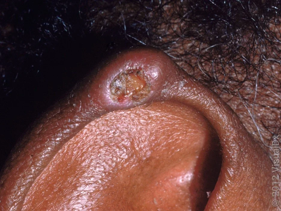 A single tophus on the ear.