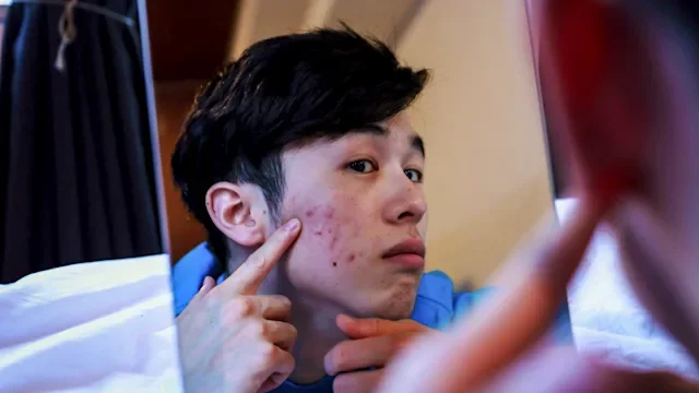 Rosacea vs. Acne: Differences and Treatments Explained (With Pictures)