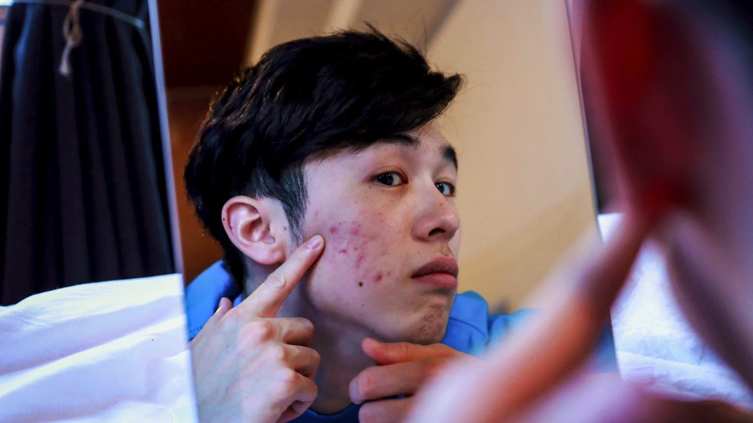 Acne vs rosacea: examining skin in mirror 1252608688