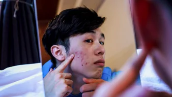 Acne vs rosacea: examining skin in mirror 1252608688