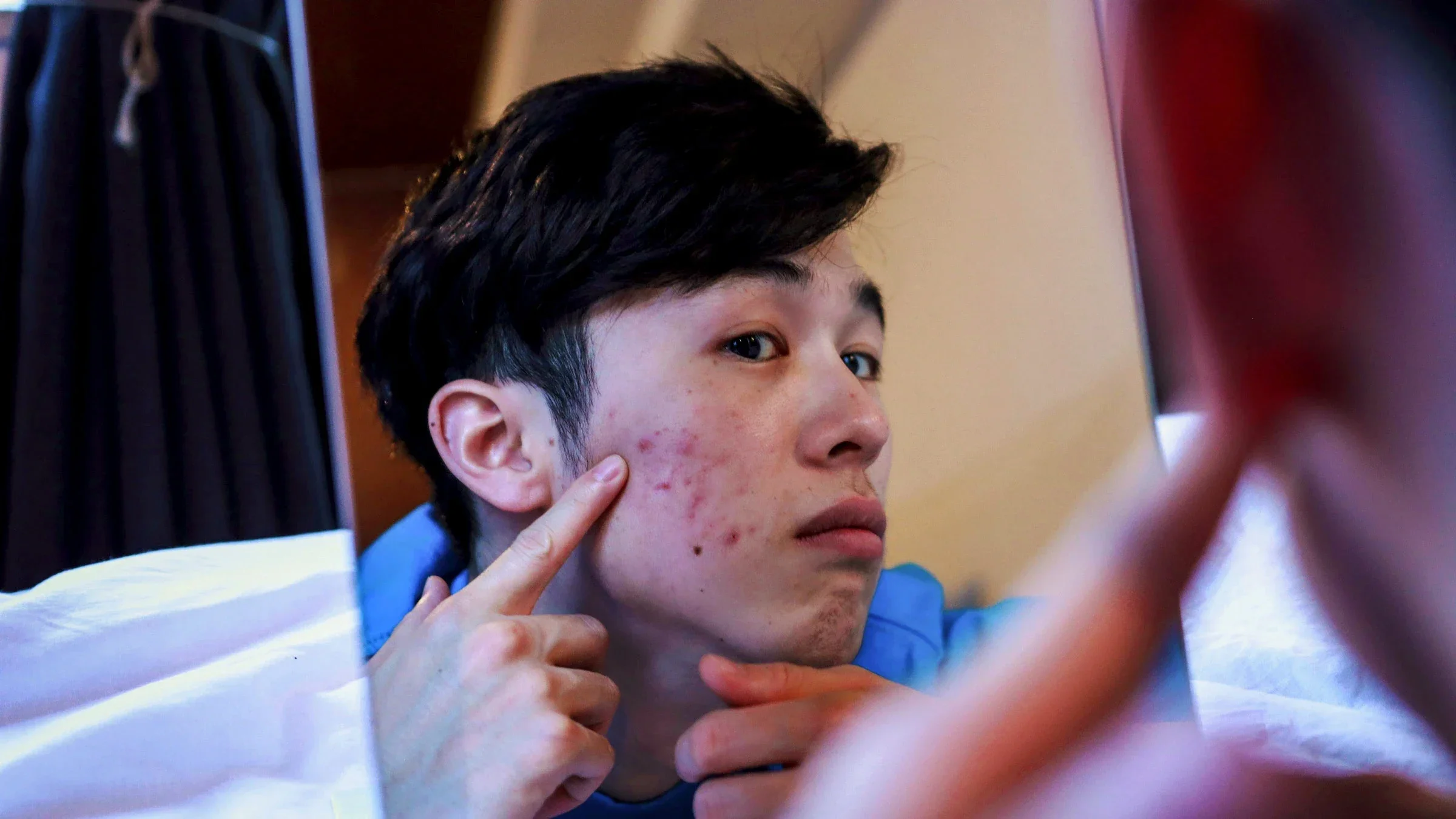 A person examining red bumps on their face in a mirror.
kyonntra/E+ via Getty Images