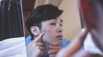 Acne vs rosacea: examining-skin-in-mirror-1252608688