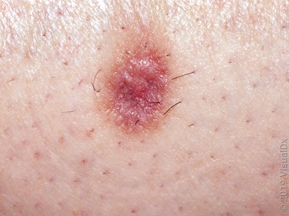 Dermatofibroma on fairer skin.