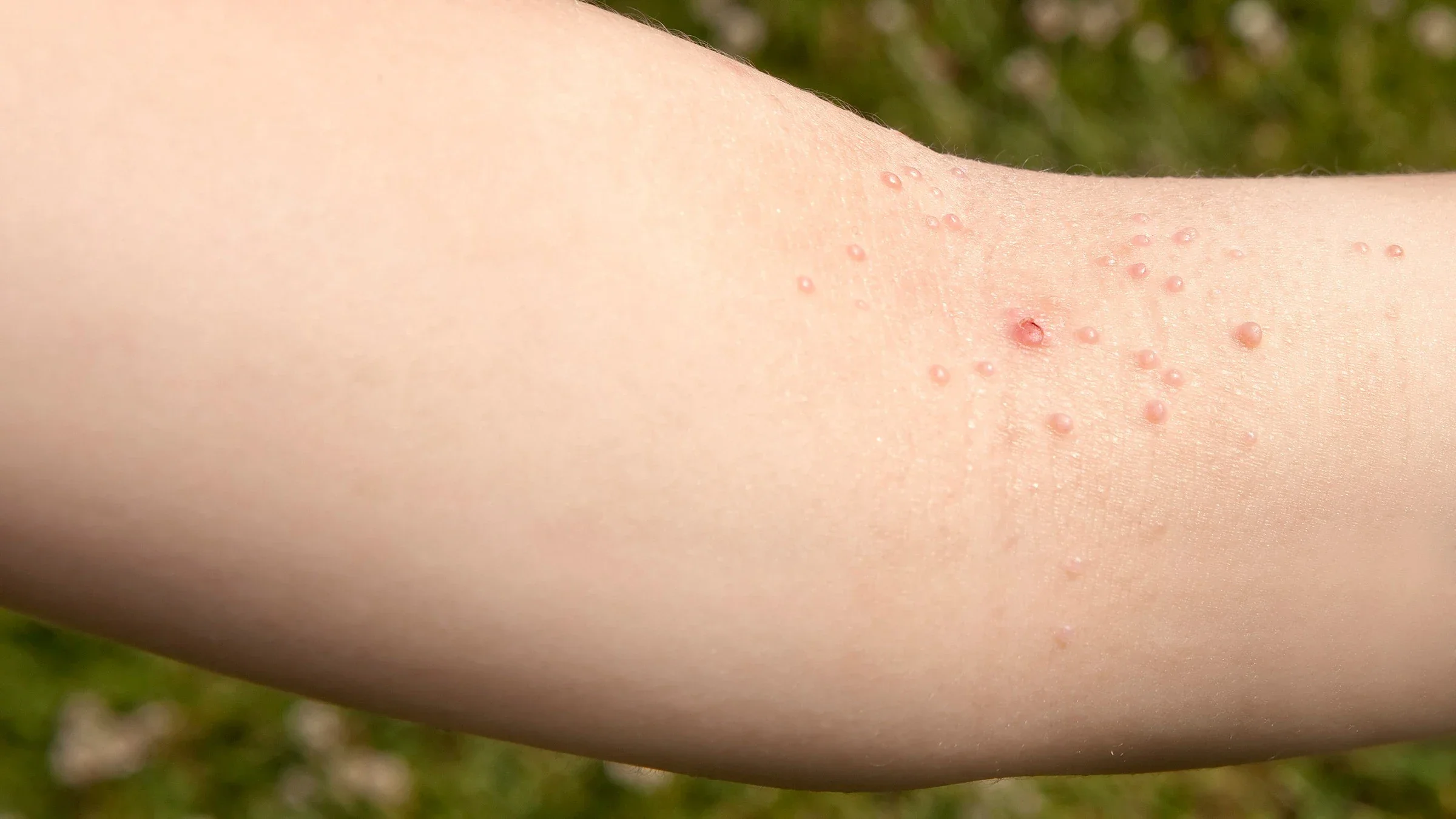 Close-up of a person's arm with Molluscum contagiosum, a viral infection of the skin.
JodiJacobson/E+ via Getty Images
