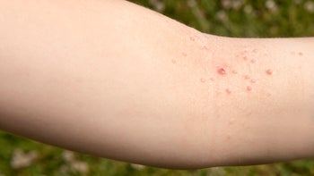 Health: Skin Infection: GettyImages-134724539