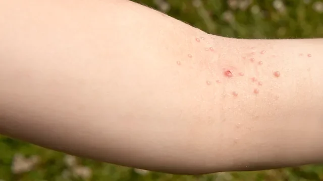 Health: Skin Infection: GettyImages-134724539