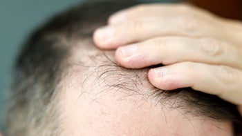 Hair loss: closeup hair loss 2157845010