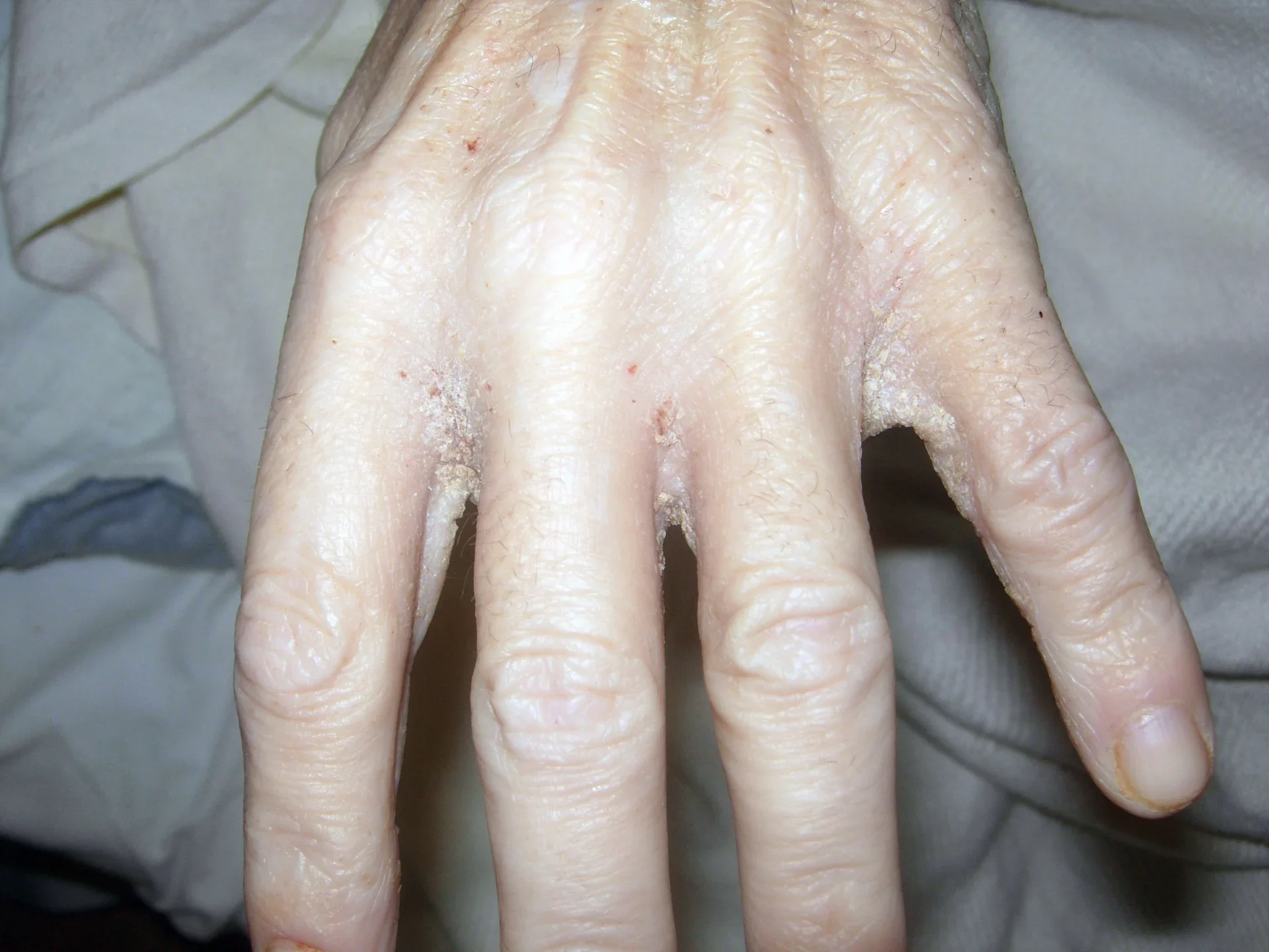 A hand with thick crusts in between the fingers in crusted scabies.