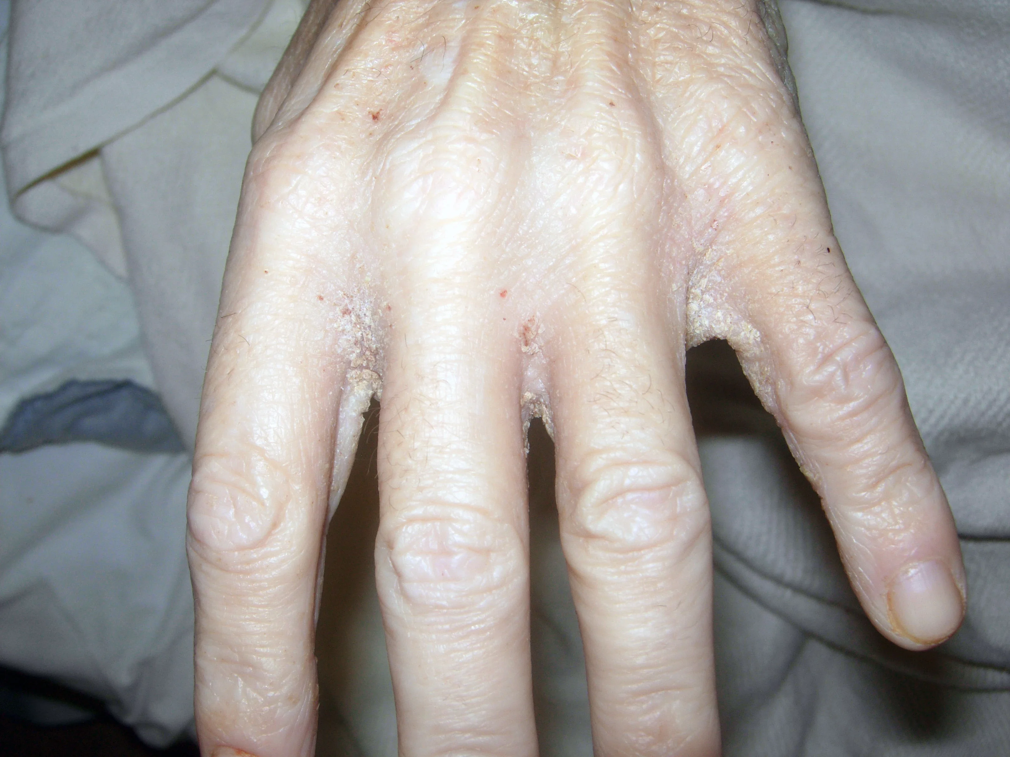 A hand with thick crusts in between the fingers in crusted scabies.