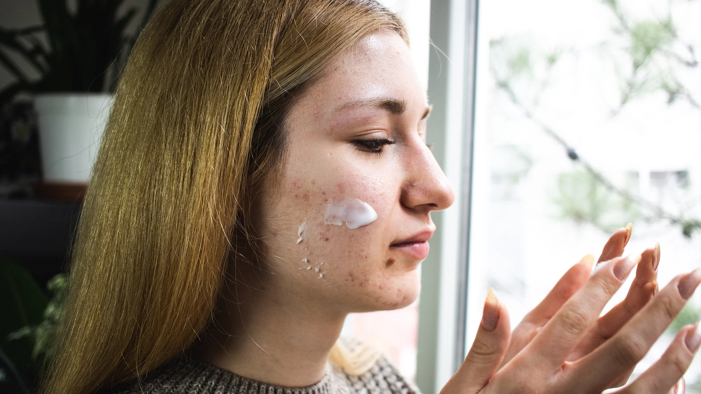 A woman with acne applies face cream on her cheek.