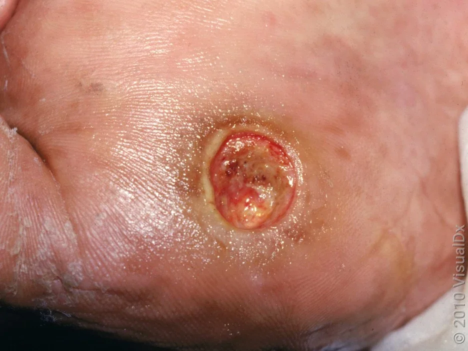A close-up look of a diabetic foot sore.