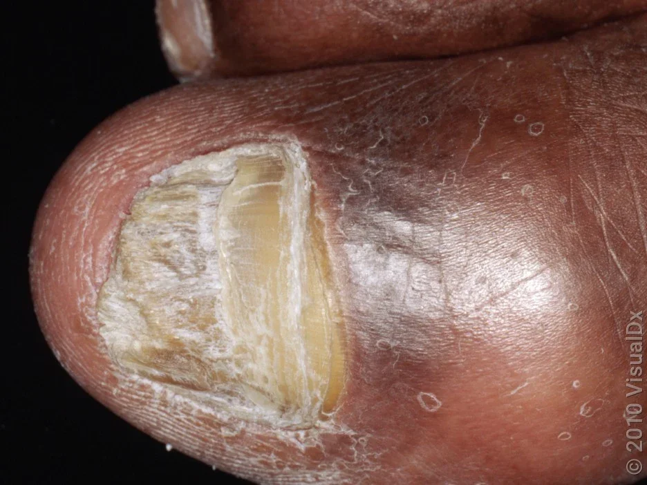 Yellow nail caused by fungus.