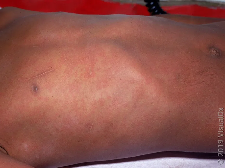 A measles rash on a child’s torso.