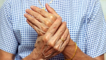 Health: Arthritis: closeup woman arthritis hands 1335301791